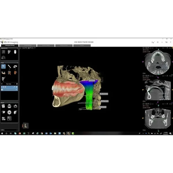 CBCT CS 9600 FOV 16x17 - imagine 3